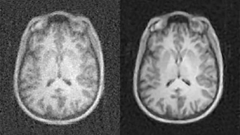 AI Dramatically Improves Medical Imaging Quality
