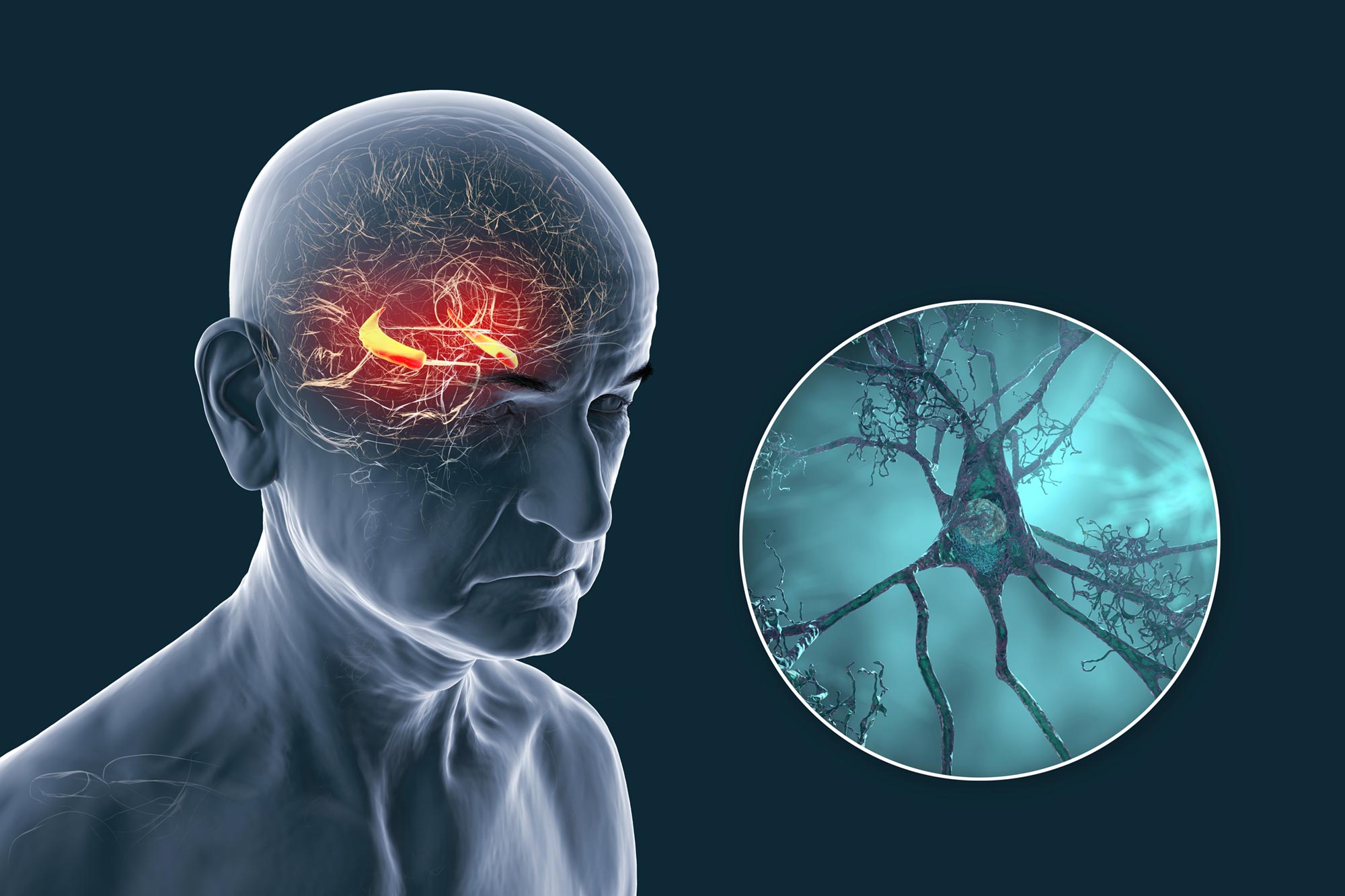 Neue Studie stellt Alzheimer-Theorien in Frage: Es geht nicht nur um Plaques