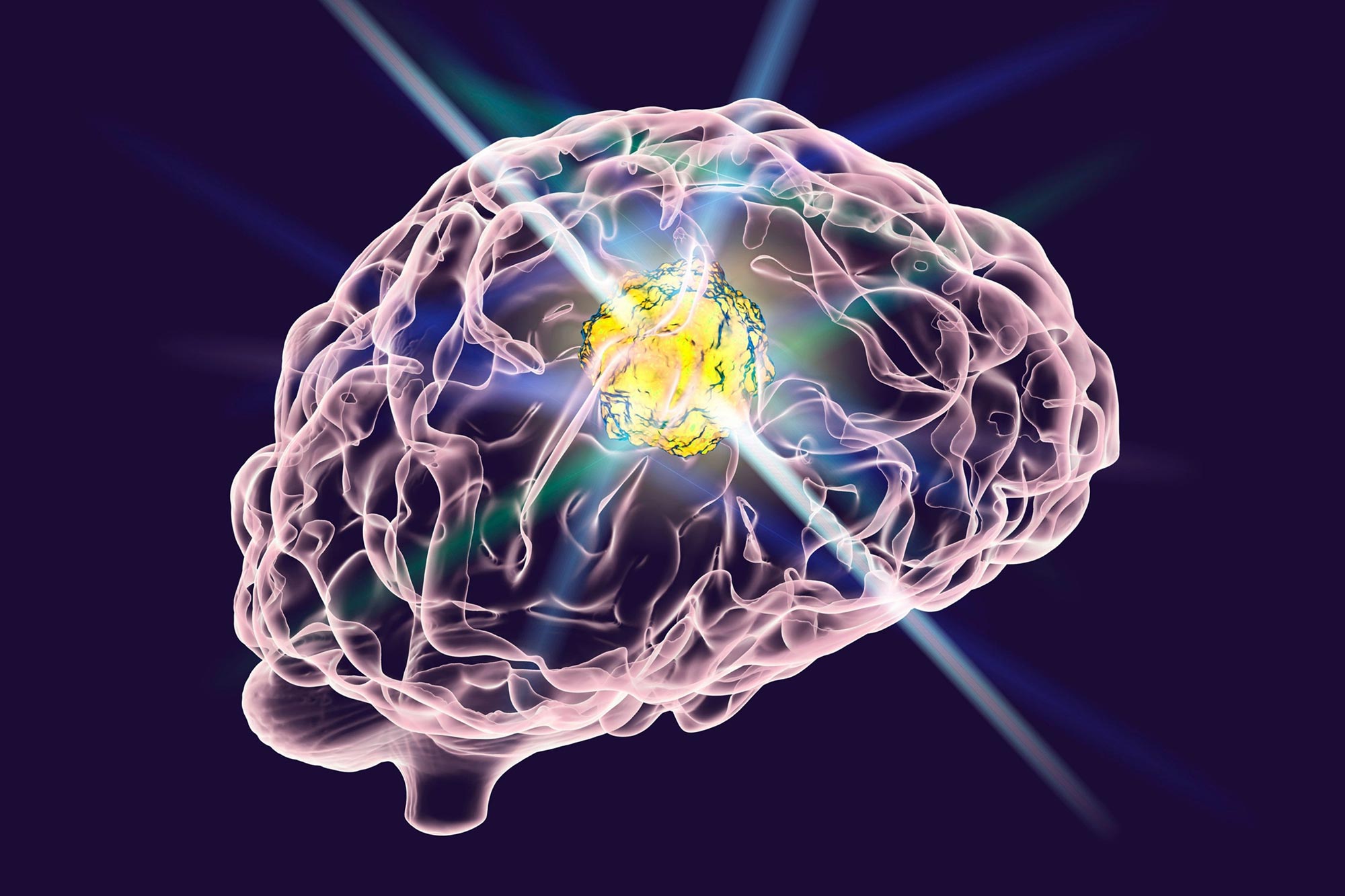 Die Entdeckung der Biomarker kann zu Blutuntersuchungen bei Hirnkrebs führen
