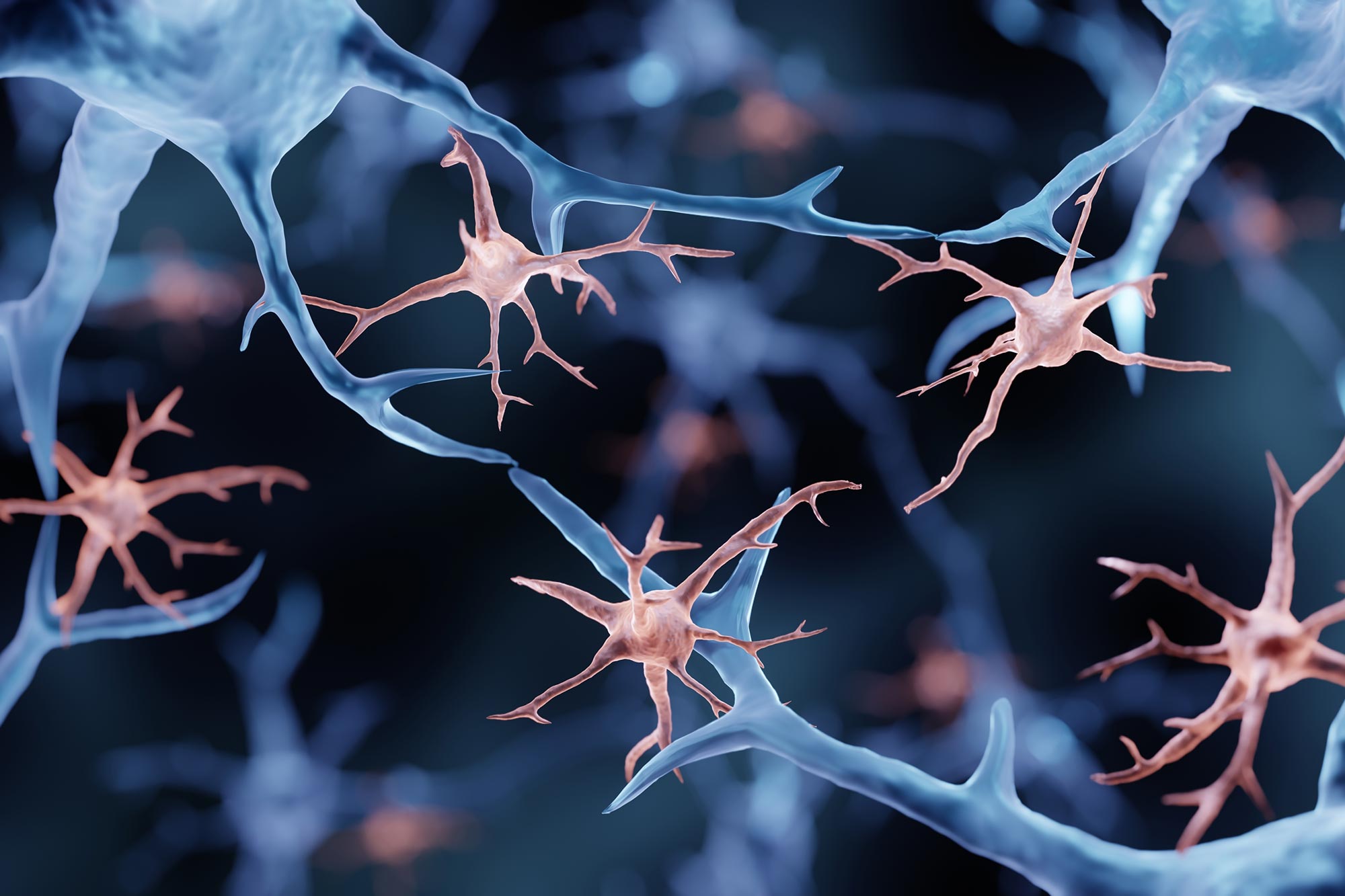 Im Gehirn gefundene krebsähnliche Mutationen könnten die Ursache für die Alzheimer-Krankheit sein