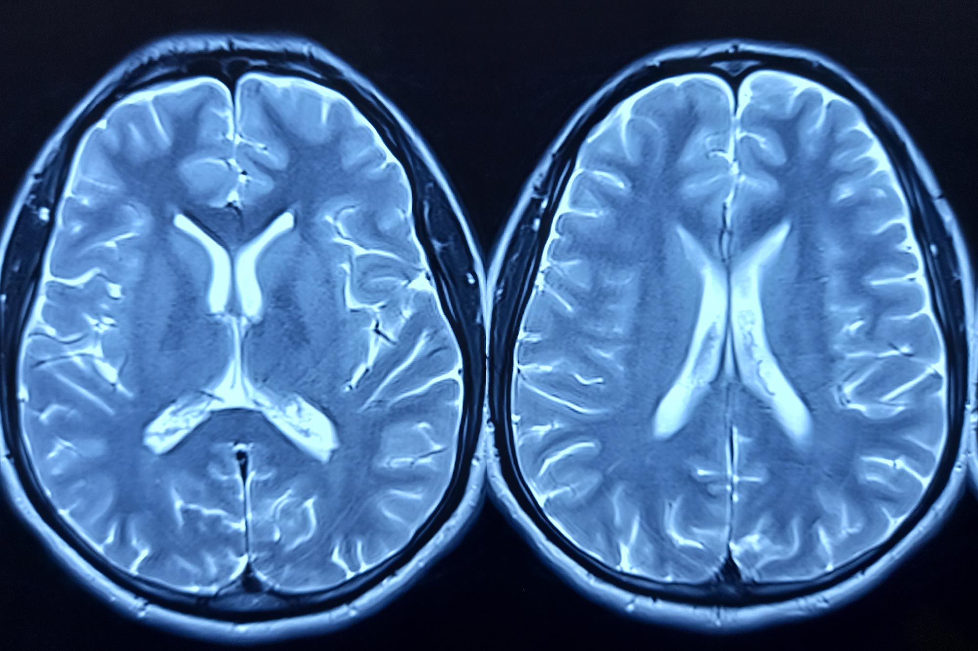Deep Brain Recordings enthüllen, wie Mounjaro Heißhungerattacken unterdrückt