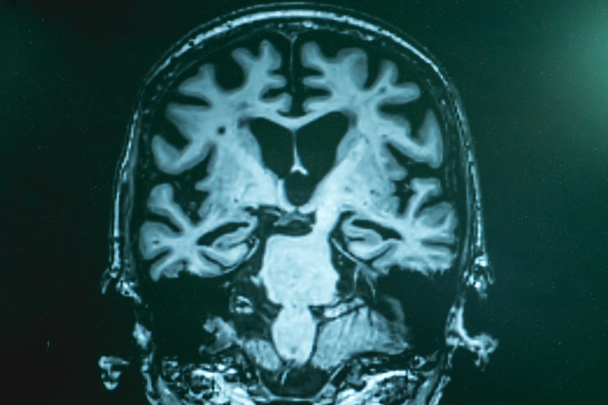 Jenseits von Amyloid-Plaques: Wissenschaftler enthüllen umfassendere chemische Störungen bei Alzheimer