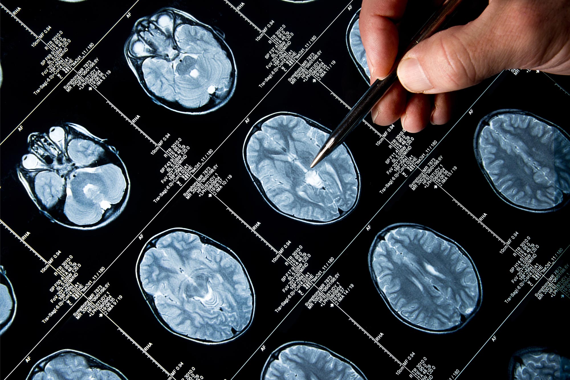 Die Entdeckung der Genmutation zeigt ein neues therapeutisches Ziel für die Parkinson 