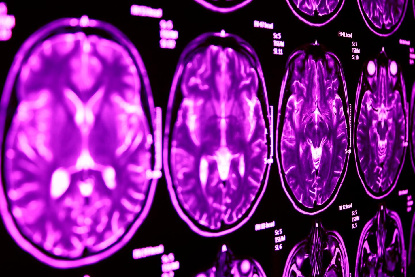 Häufiger genetischer Zusammenhang zwischen Autismus und Tourette's entdeckt 