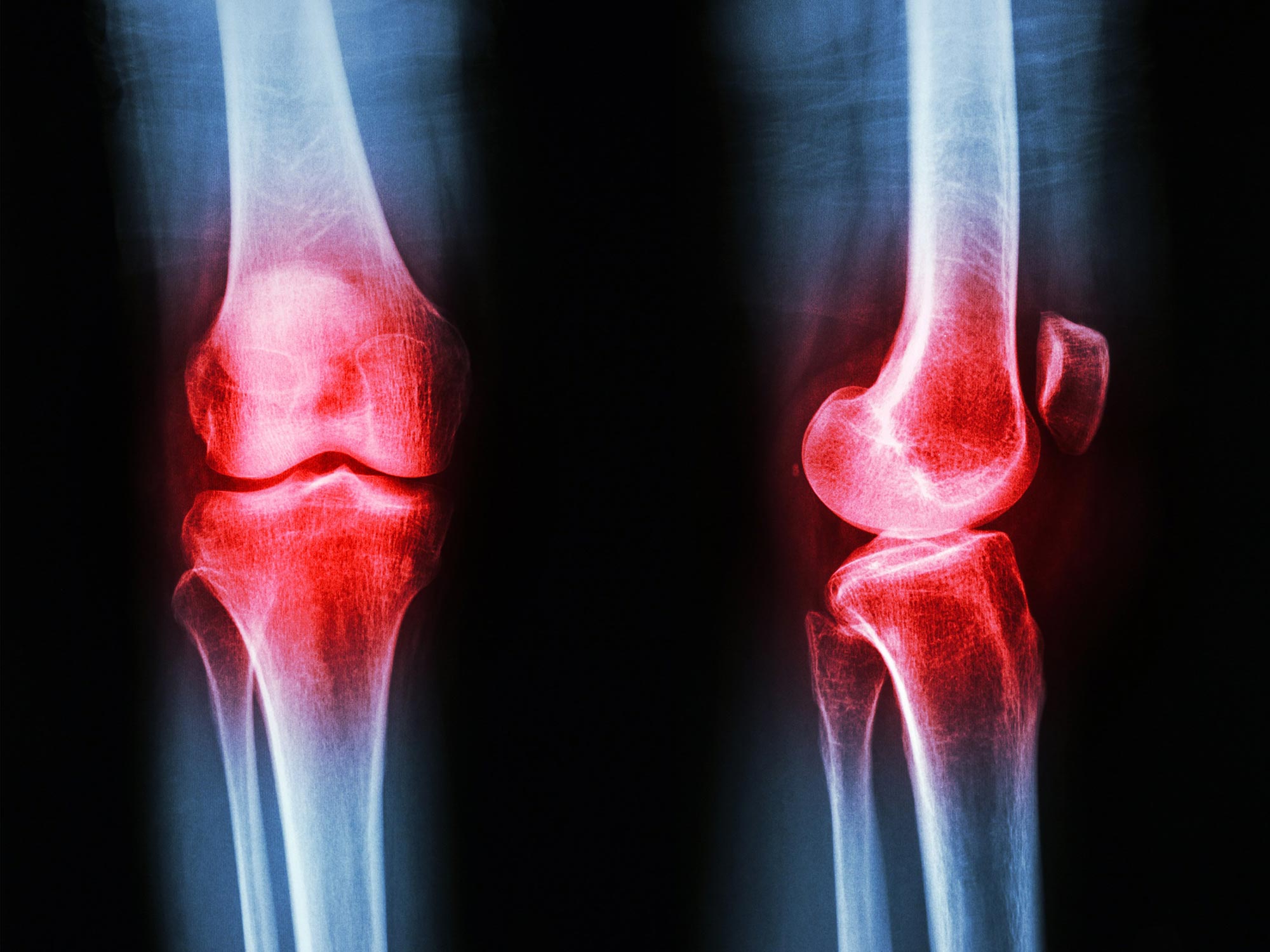 Eine unerwartete Entdeckung eines Hormons könnte die Art und Weise verändern, wie wir Arthritis behandeln