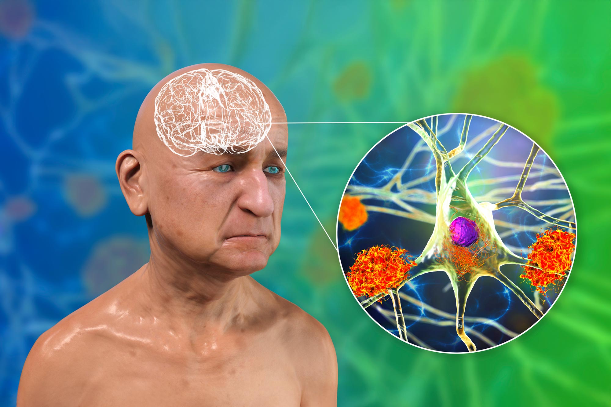 Neue Studie stellt jahrzehntelanges Alzheimer-Verständnis mit der Entdeckung von Mikrotubuli in Frage