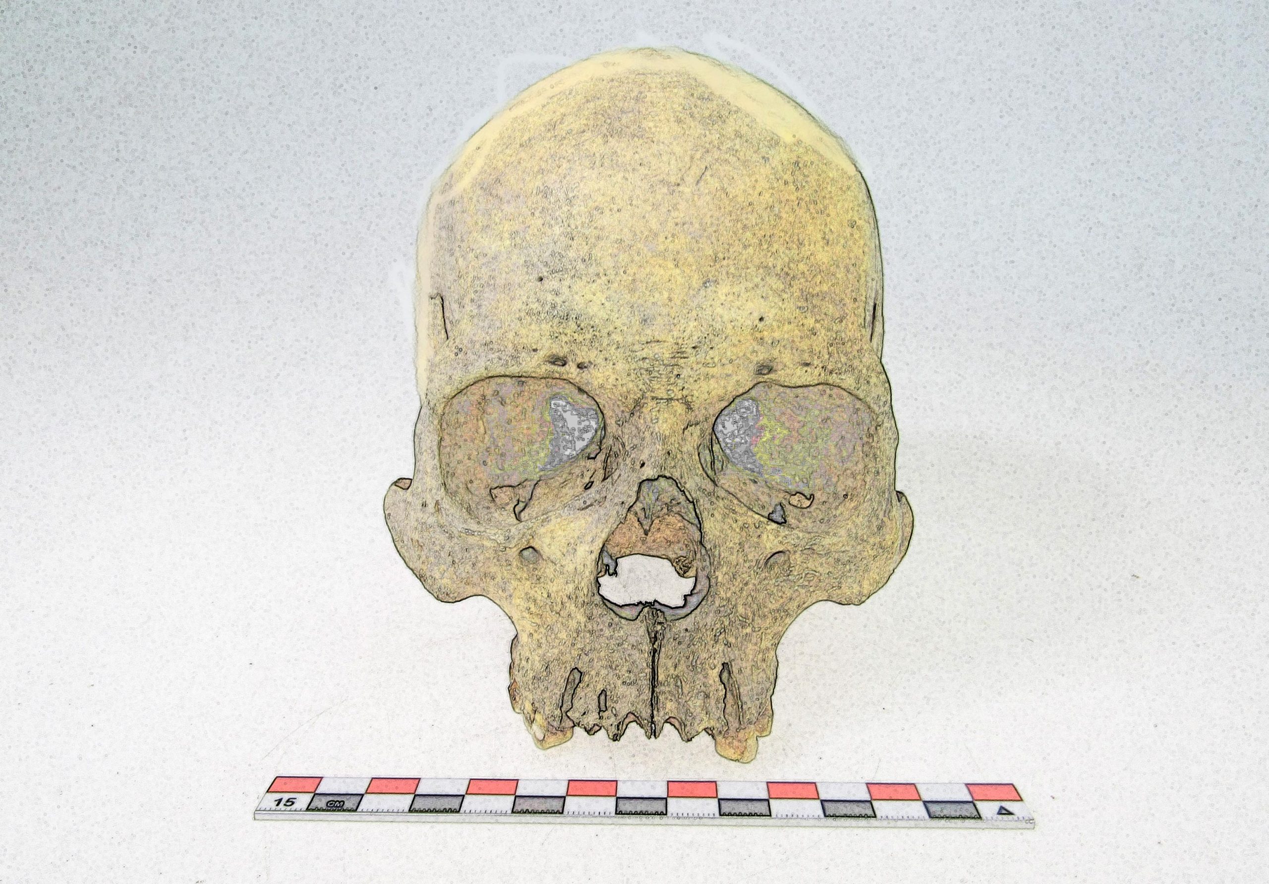 Vor Columbus: Ein 4.000 Jahre altes Skelett zeigt eine seltene Lepra-Belastung in Amerika