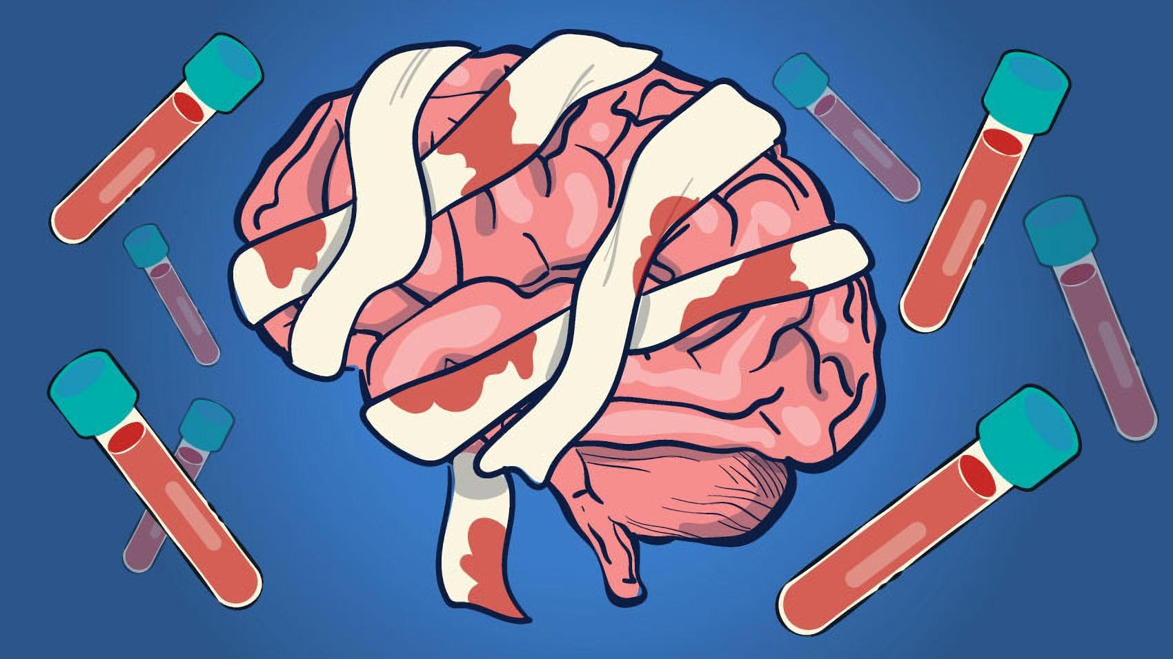 Frühe Blutuntersuchungen bei traumatischen Hirnverletzungen können genau vorhersagen, welche Patienten wahrscheinlich sterben werden