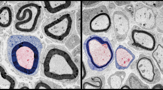 Das Wachstum der weißen Substanzen des Gehirns könnte die Alphabetisierung vorhersagen